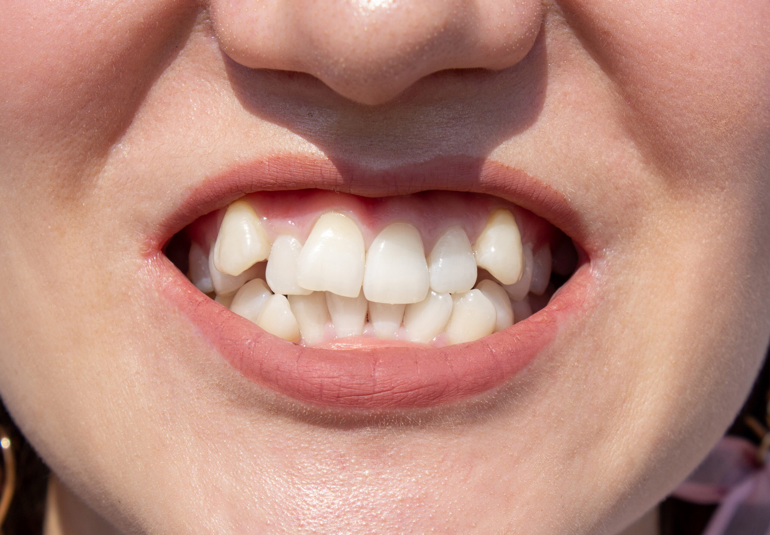 Overcrowded Teeth in Buffalo, NY | Free Consults [Video Guide]