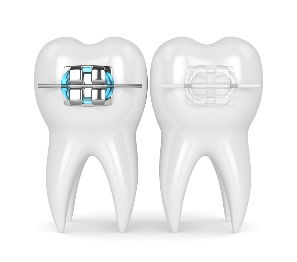 Ceramic Braces vs. Metal Braces in WNY | Free Consultations 🦷