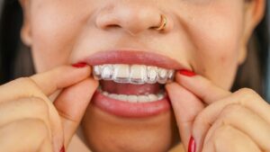 Invisalign vs. Metal Braces in Buffalo, NY | Free Orthodontics Consult
