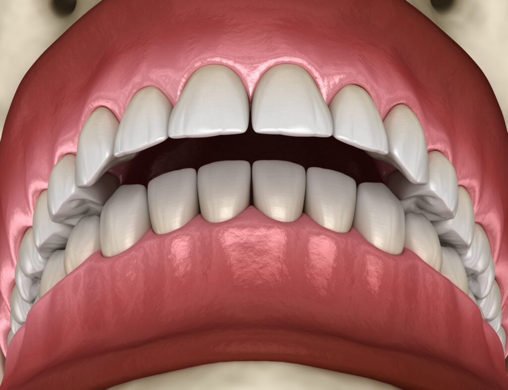 Normal Bite vs. Overbite in Buffalo, NY | Free Consult [Video Q&A]