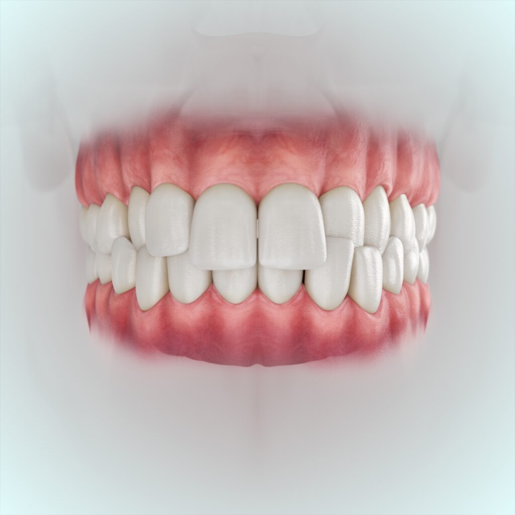 Crossbites in Buffalo, NY | Free Ortho Consults [Video Breakdown]