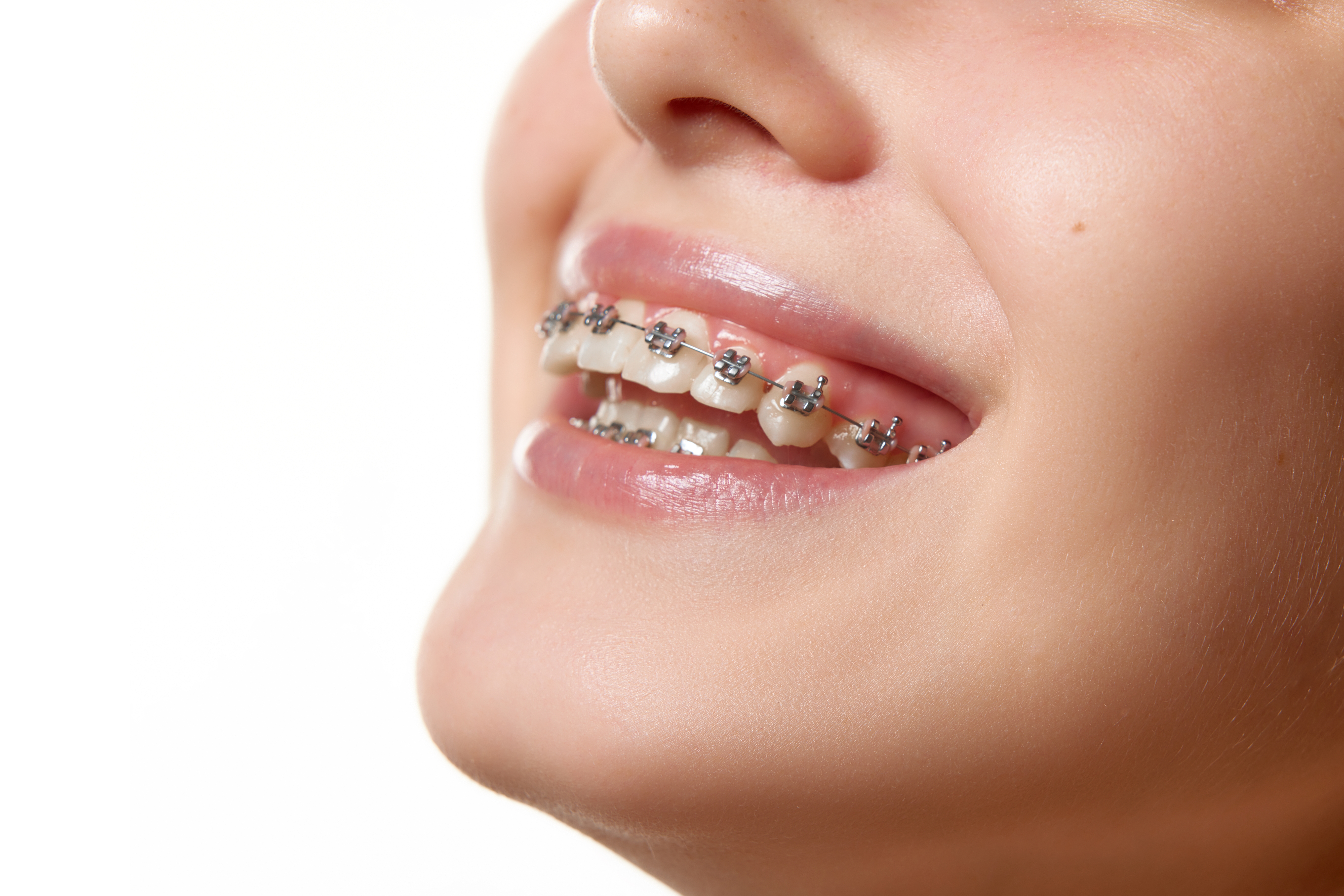Orthodontist that Accepts Medicaid in Buffalo, NY | Free Consults!